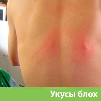 Укусы блох в Саранске