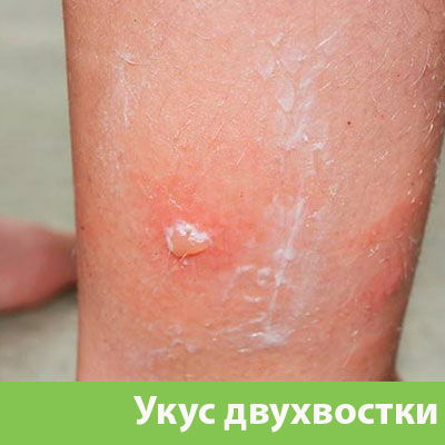 Укус двухвостки в Саранске