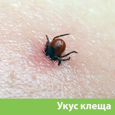 Укус клеща в Саранске