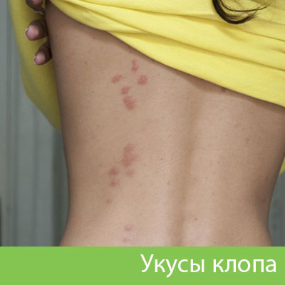 Профессиональное уничтожение клопов в Саранске